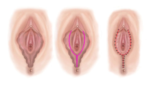 会陰部 肛門のたるみの治療ならルクスクリニック 新宿にある美容外科 美容皮膚科 婦人科形成
