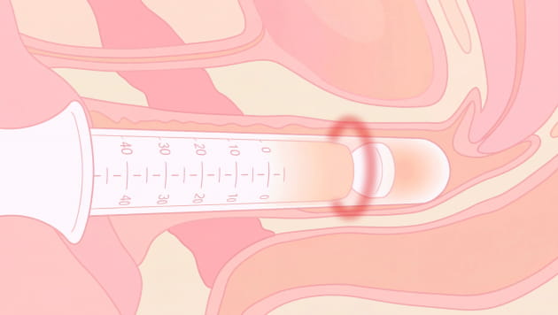 インティマレーザー