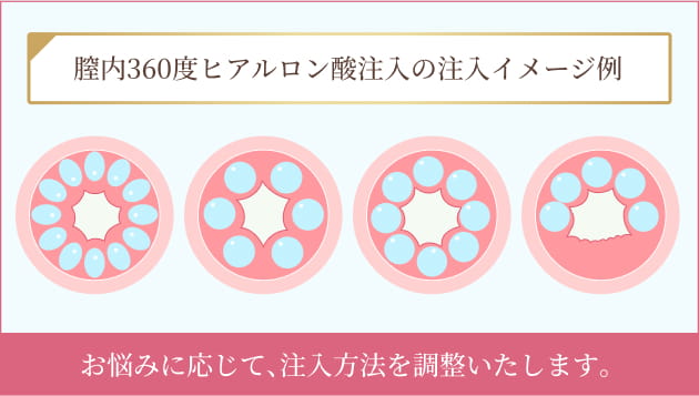 膣ヒアルロン酸