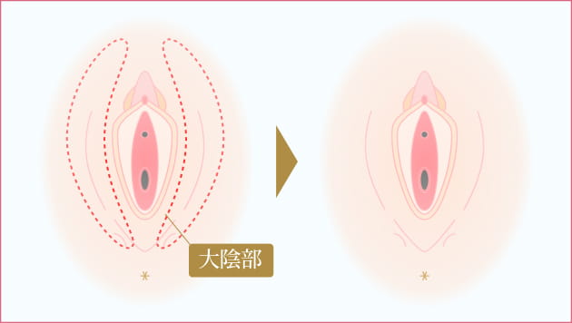 大陰唇縮小術