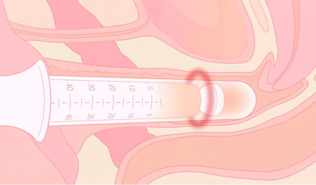 インティマレーザー