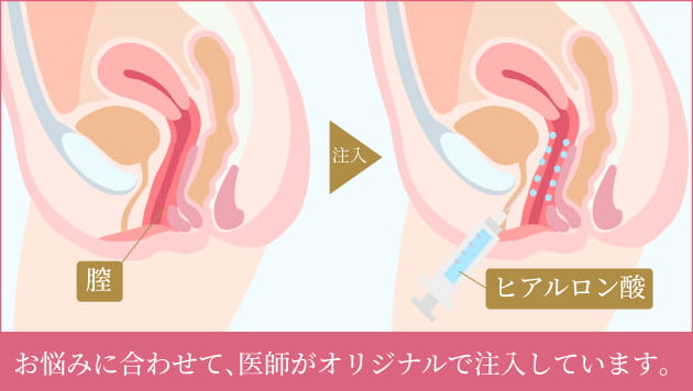 膣ヒアルロン酸