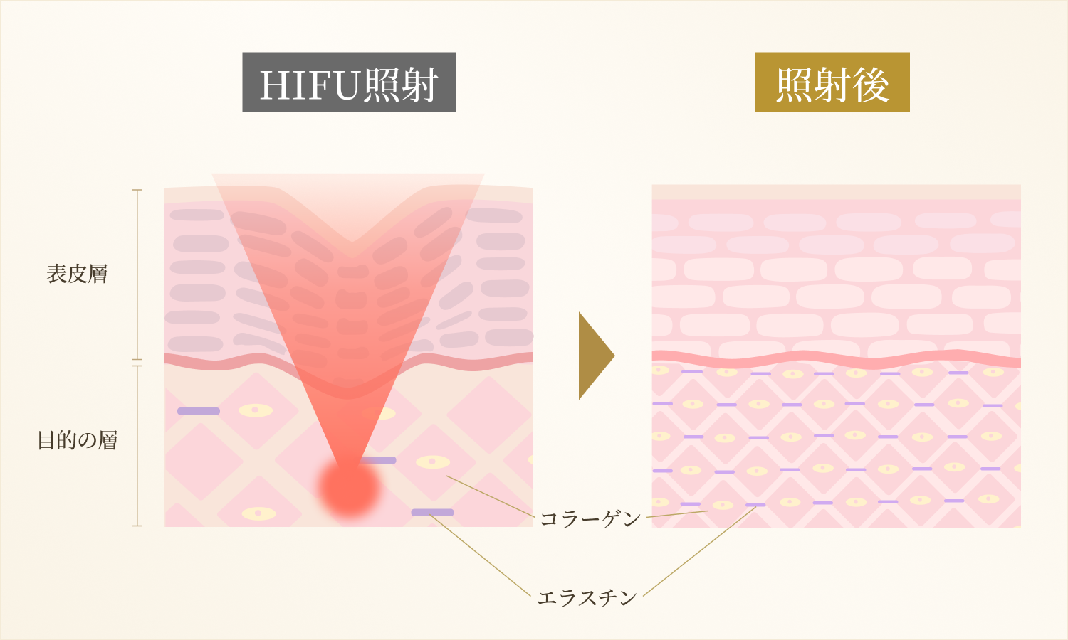 HIFUがコラーゲンやエラスチンに働きかける様子