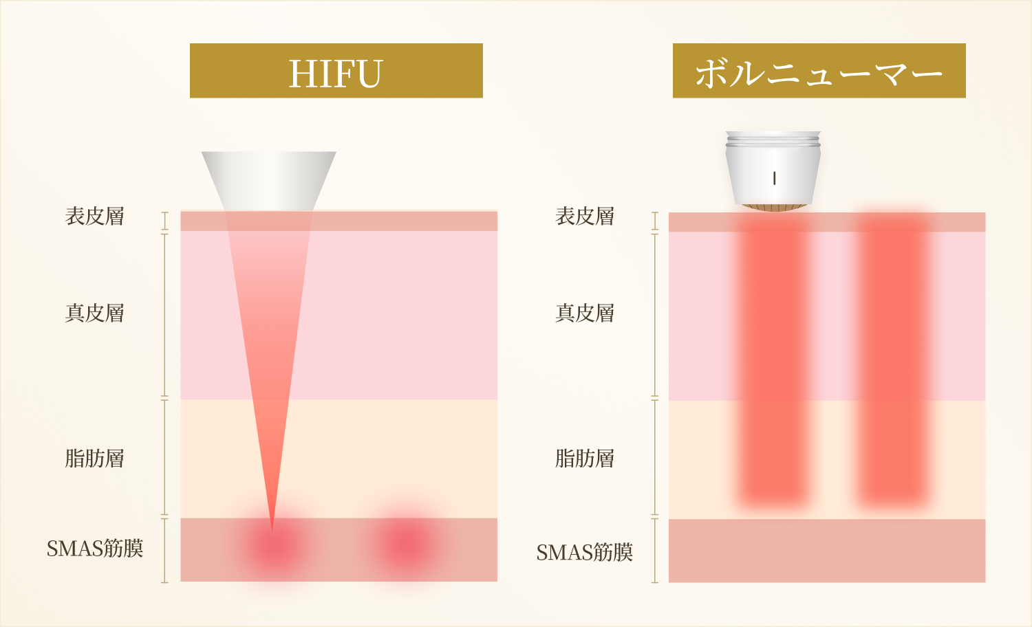 HIFUとボルニューマーの働きかけ方の違い