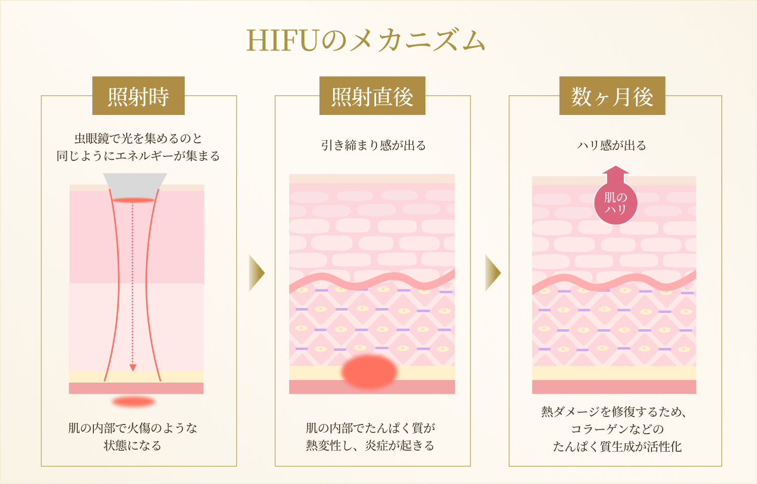 HIFUのメカニズムと効果の説明