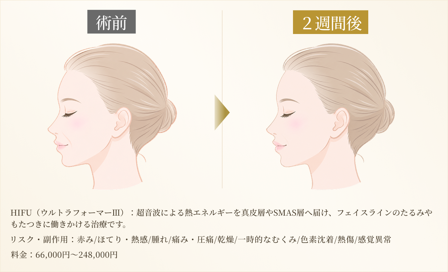 HIFUによる引き締めのイメージ画像