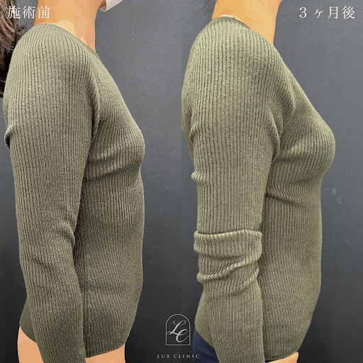シリコンバッグ豊胸の施術前と3ヶ月後の比較画像