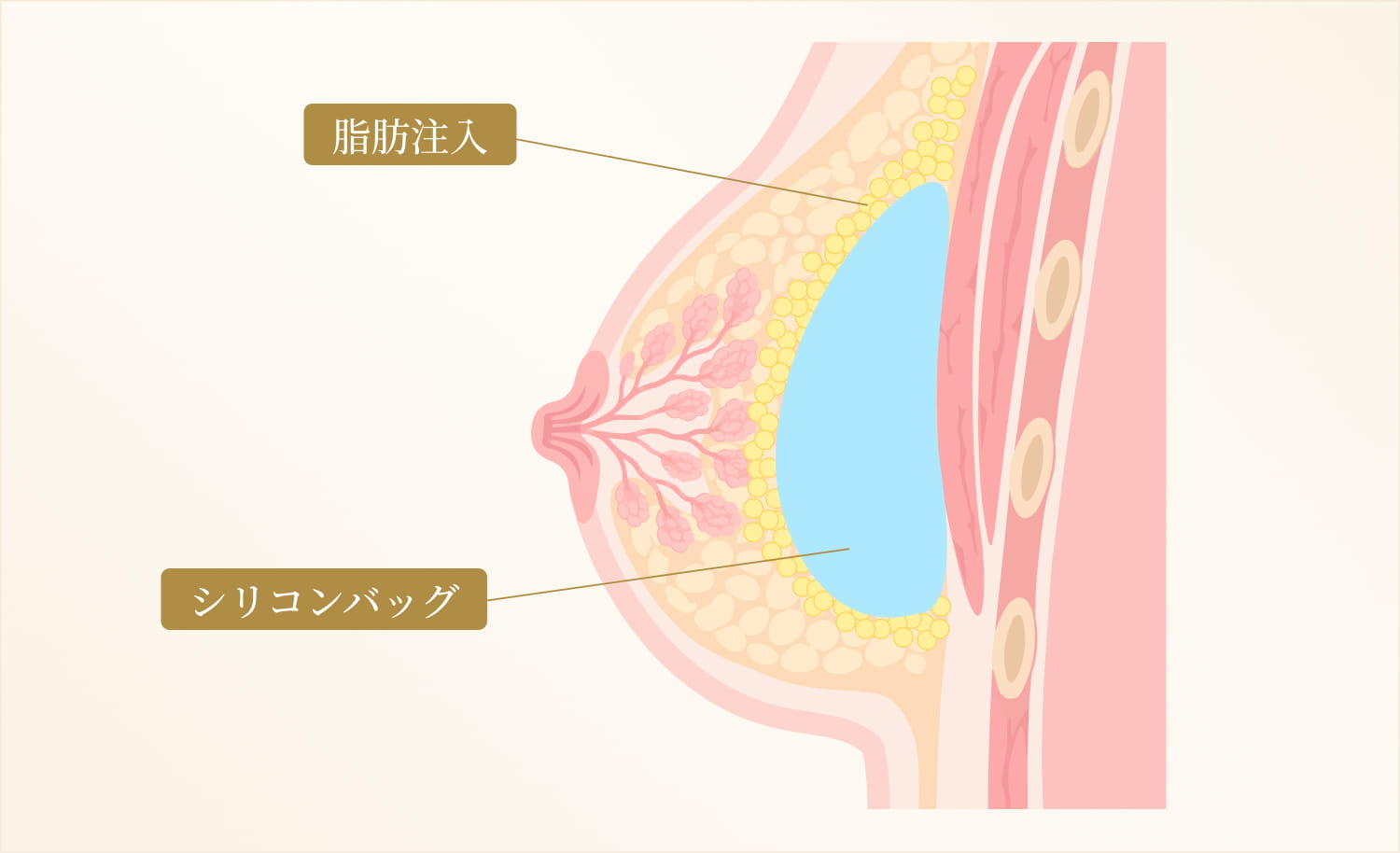 シリコンバッグと脂肪注入を行ったシェーマ画像