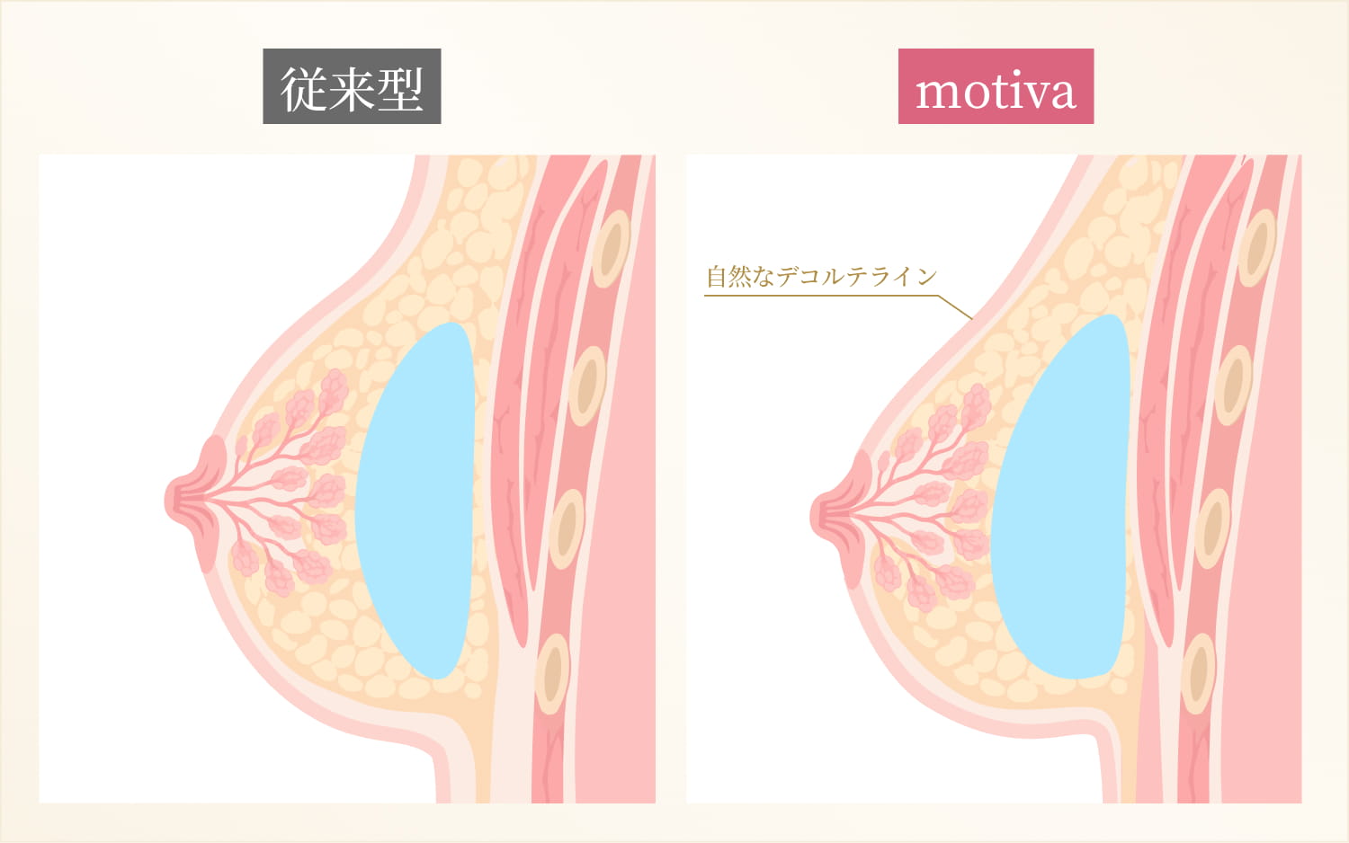 従来型とMotivaのシリコンバッグの違い