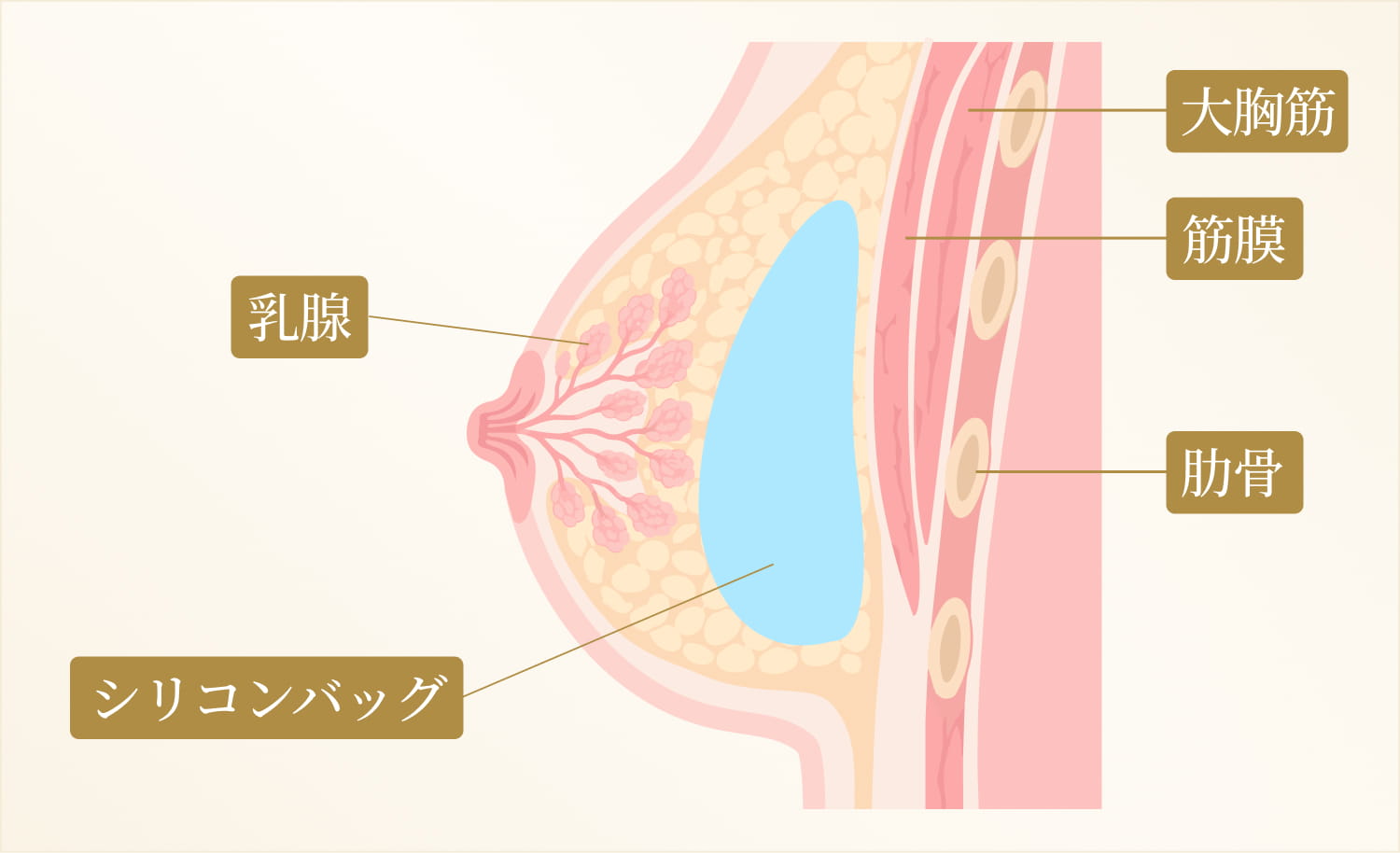 バストにシリコンバッグを入れたシェーマ画像
