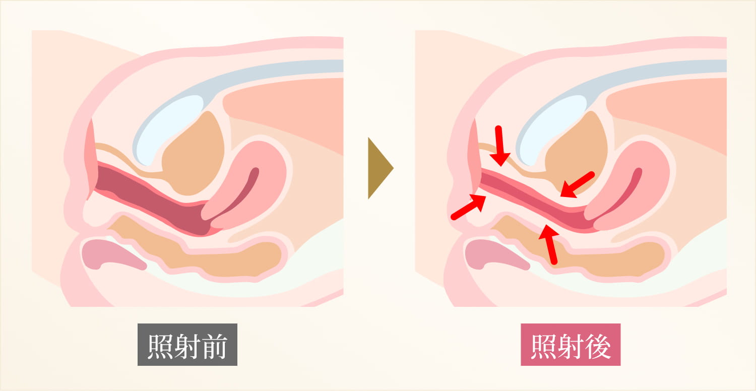 膣の引き締め・尿漏れの改善