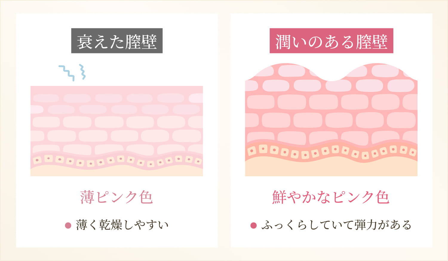 インティマレーザー膣壁変化