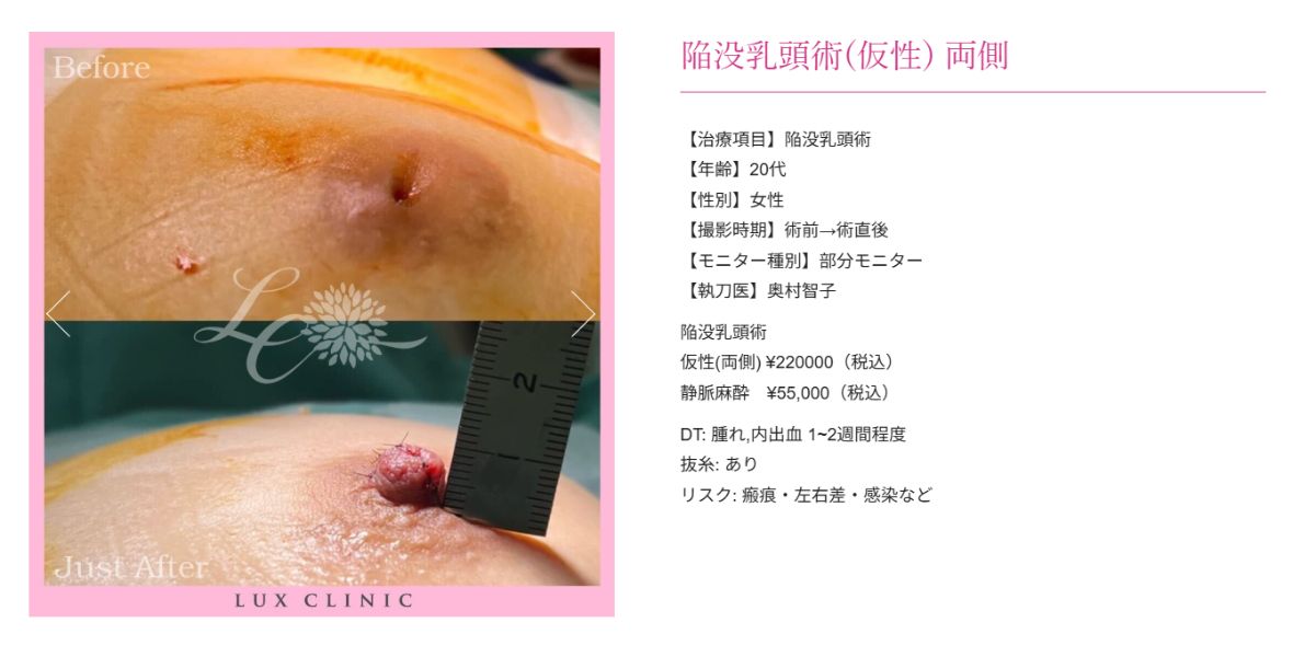 陥没乳頭
