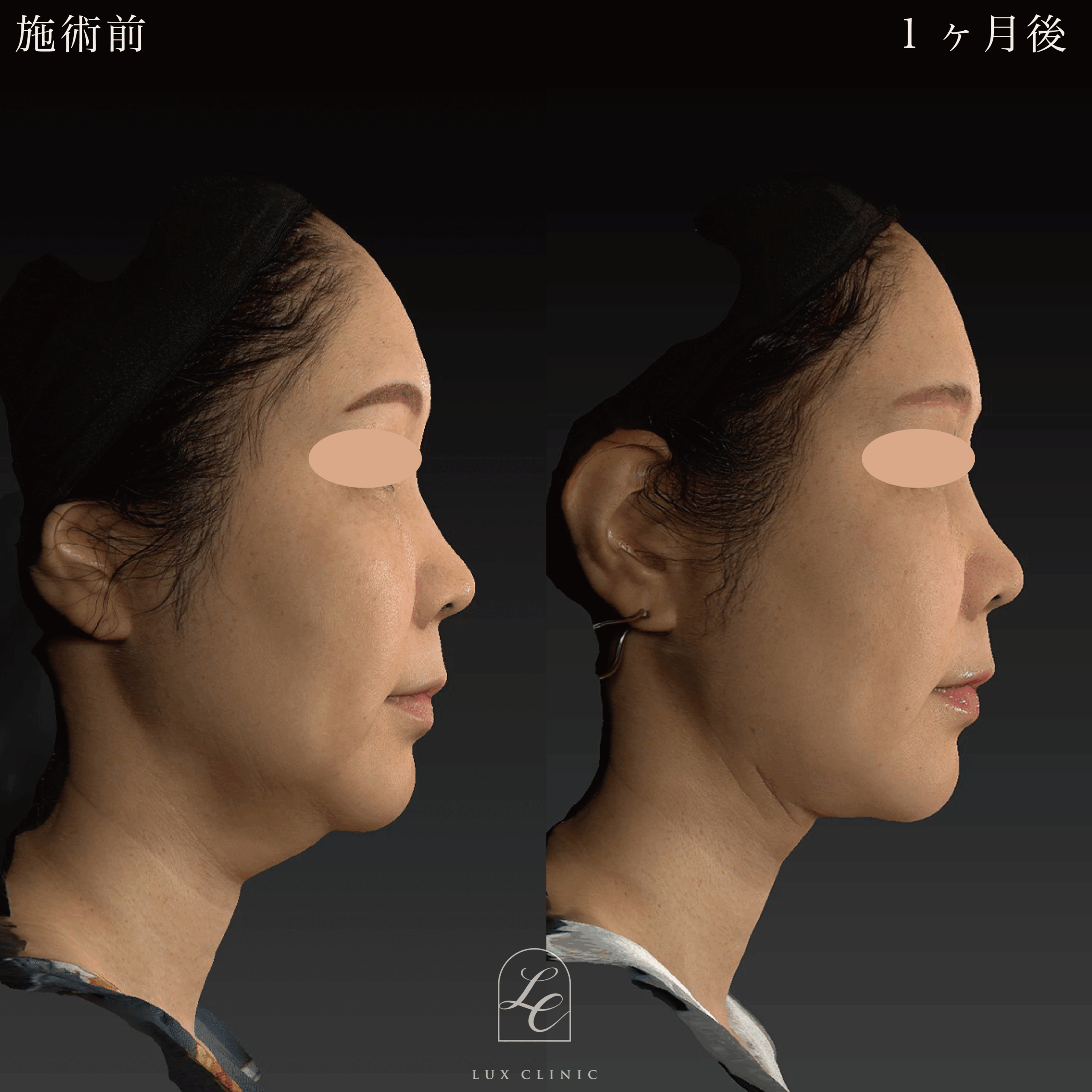 裁断済 スキル美容外科手術アトラス II、脂肪吸引・注入術 顔の脂肪 
