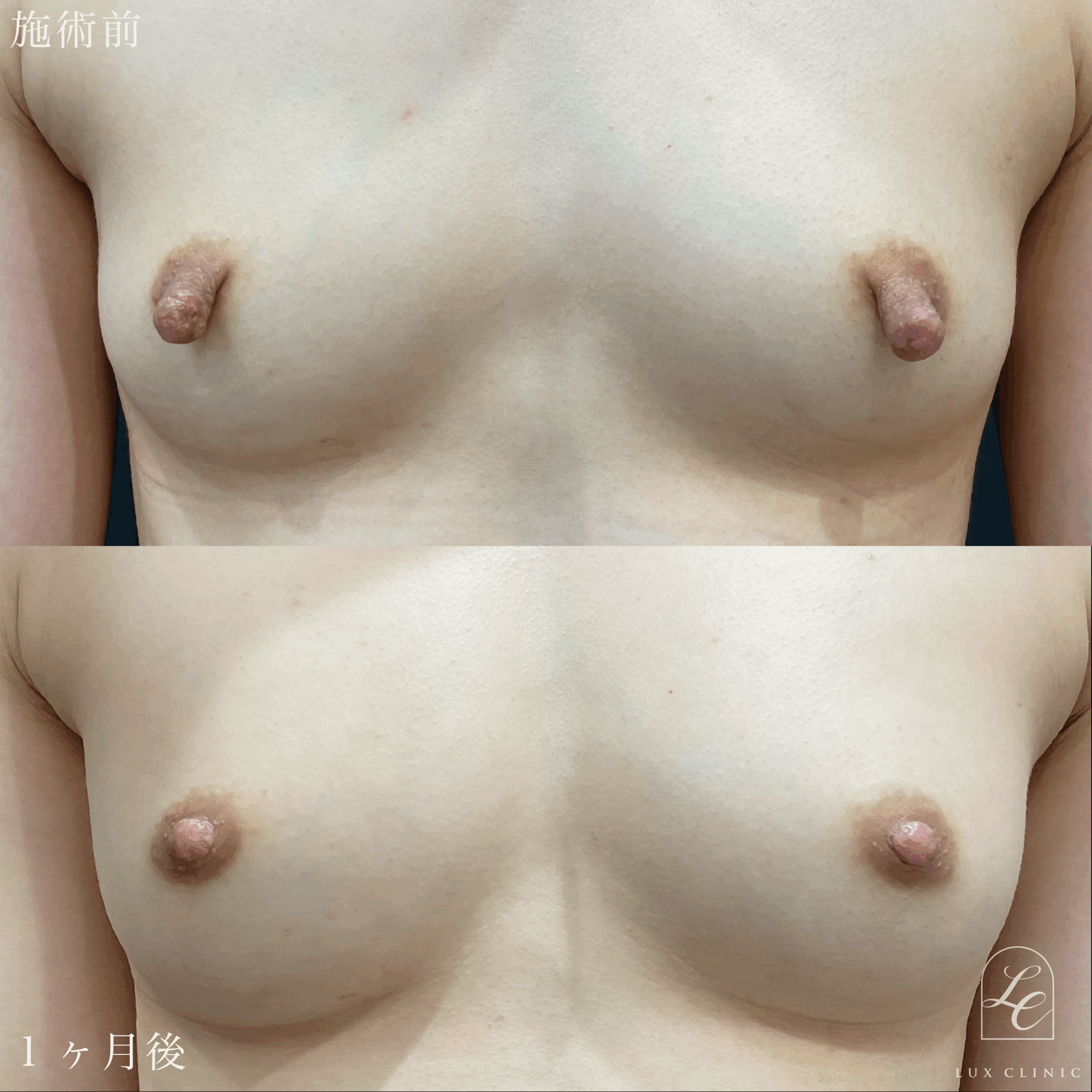 乳頭のサイズ・形状の調整の症例写真