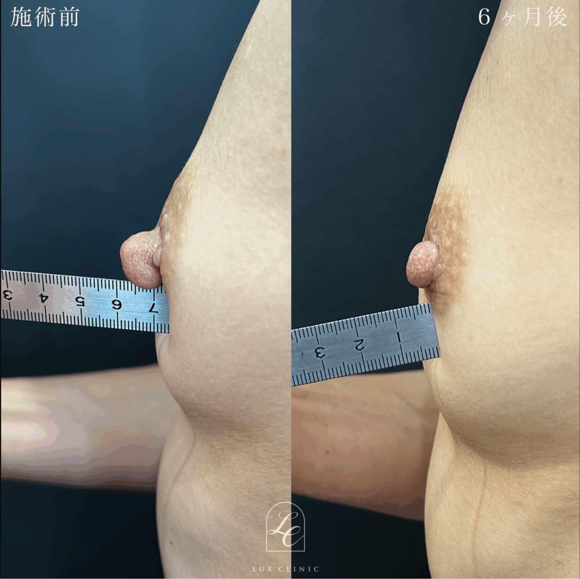 傷跡に配慮した施術の症例写真