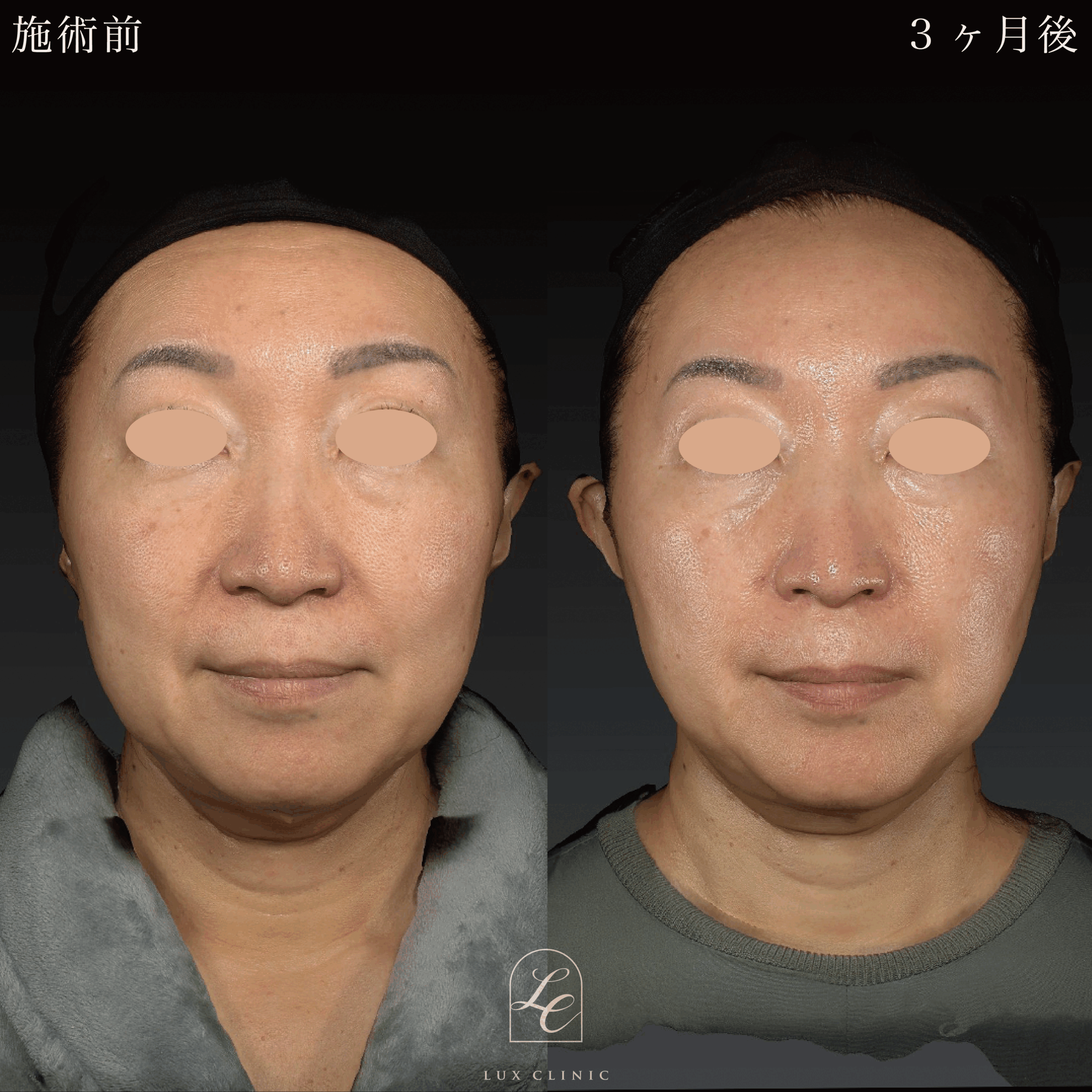糸リフト施術前と3ヶ月後の女性の顔の変化（フェイスラインの引き締め）