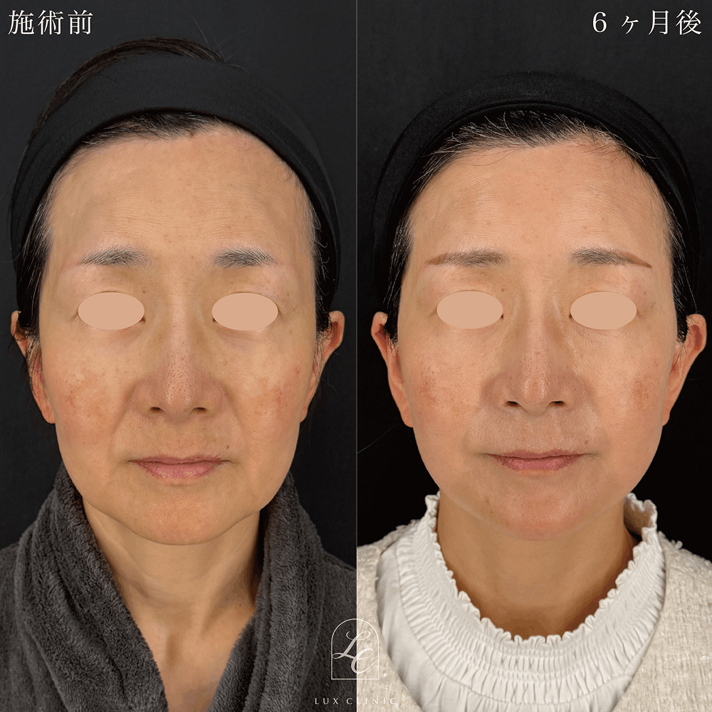 施術前後の女性の顔比較