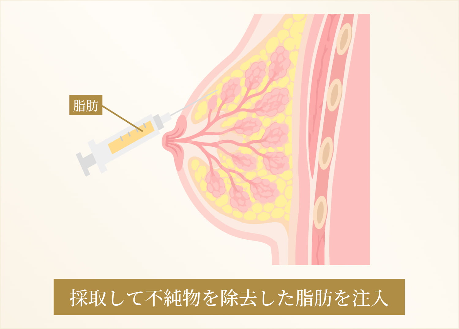 脂肪を注入するコンデンスリッチ豊胸のシェーマ画像
