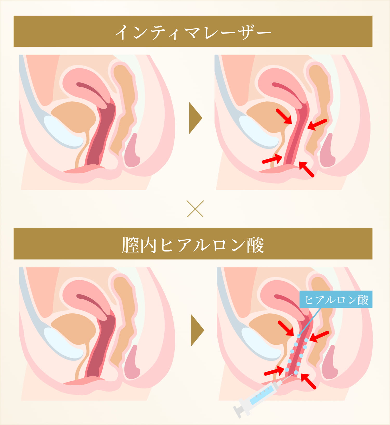 インティマレーザー×膣内ヒアルロン酸