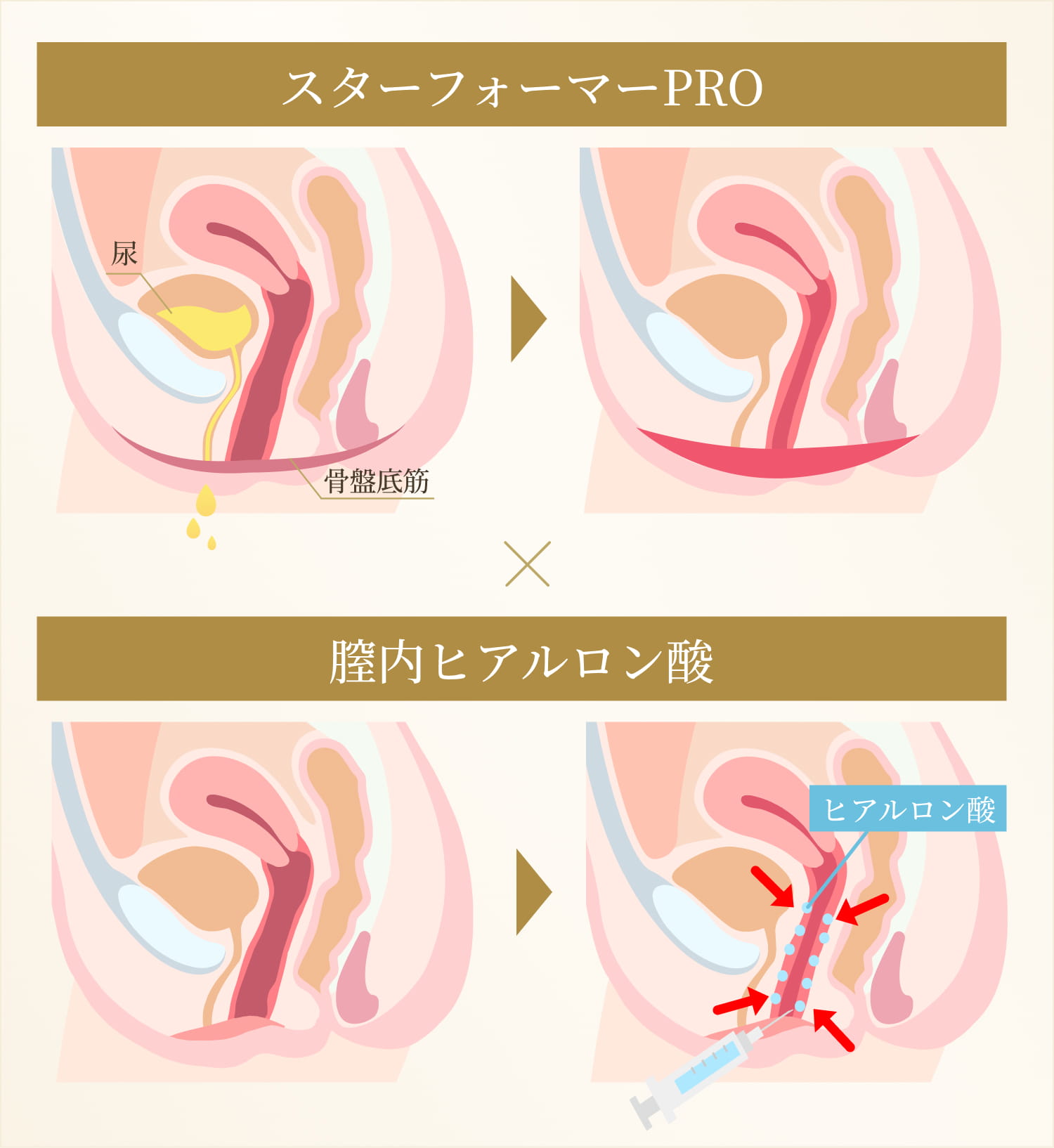 スターフォーマー×膣内ヒアルロン酸