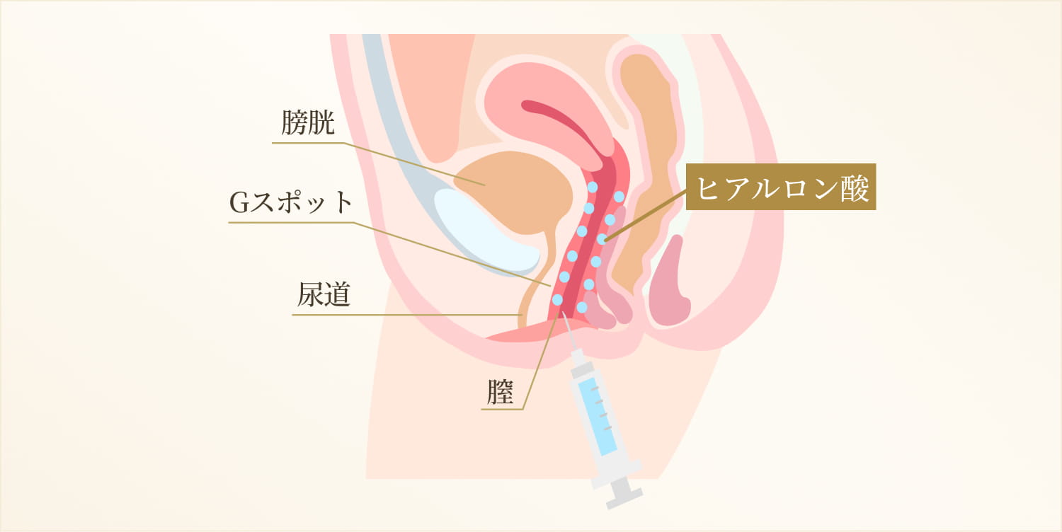 膣内ヒアルロン酸注入とは？