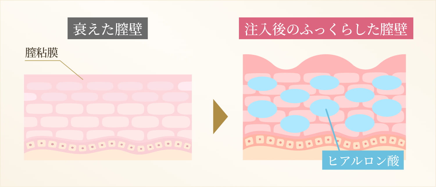 膣壁の変化