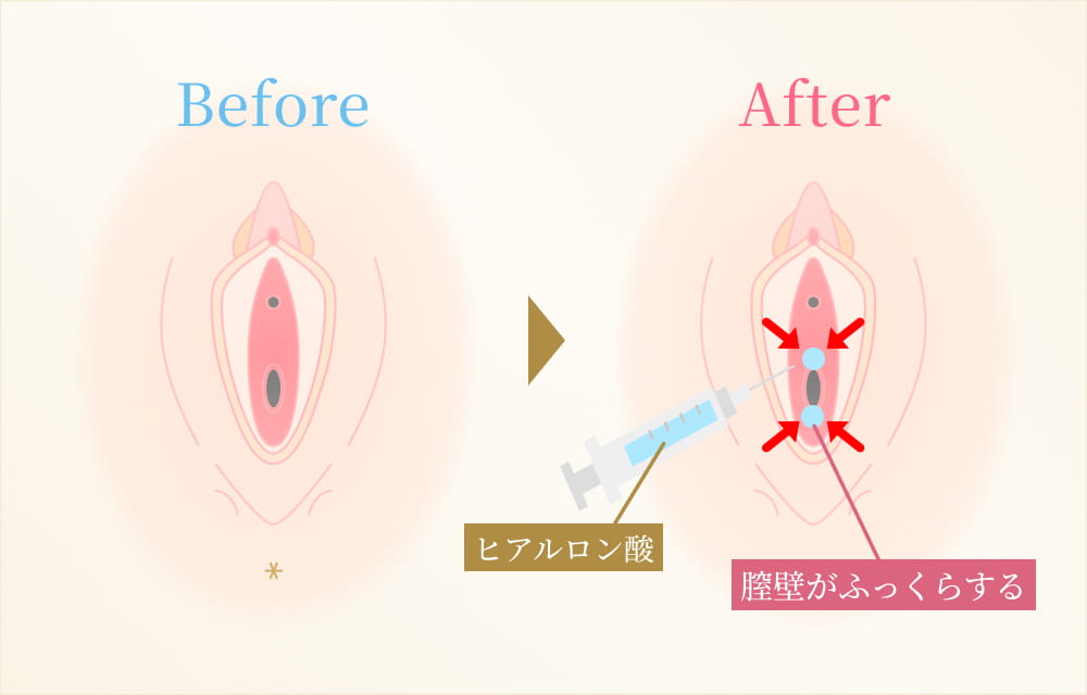 膣のゆるみが気になる方へ