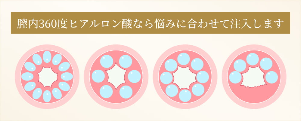 患者様一人ひとりに合わせたオリジナル注入法
