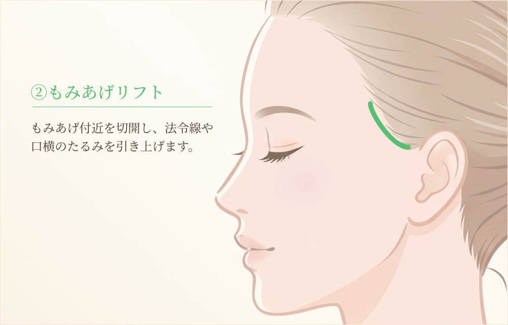 もみあげリフト切開位置