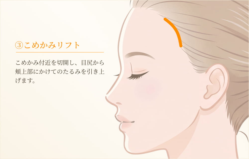 こめかみリフト切開位置