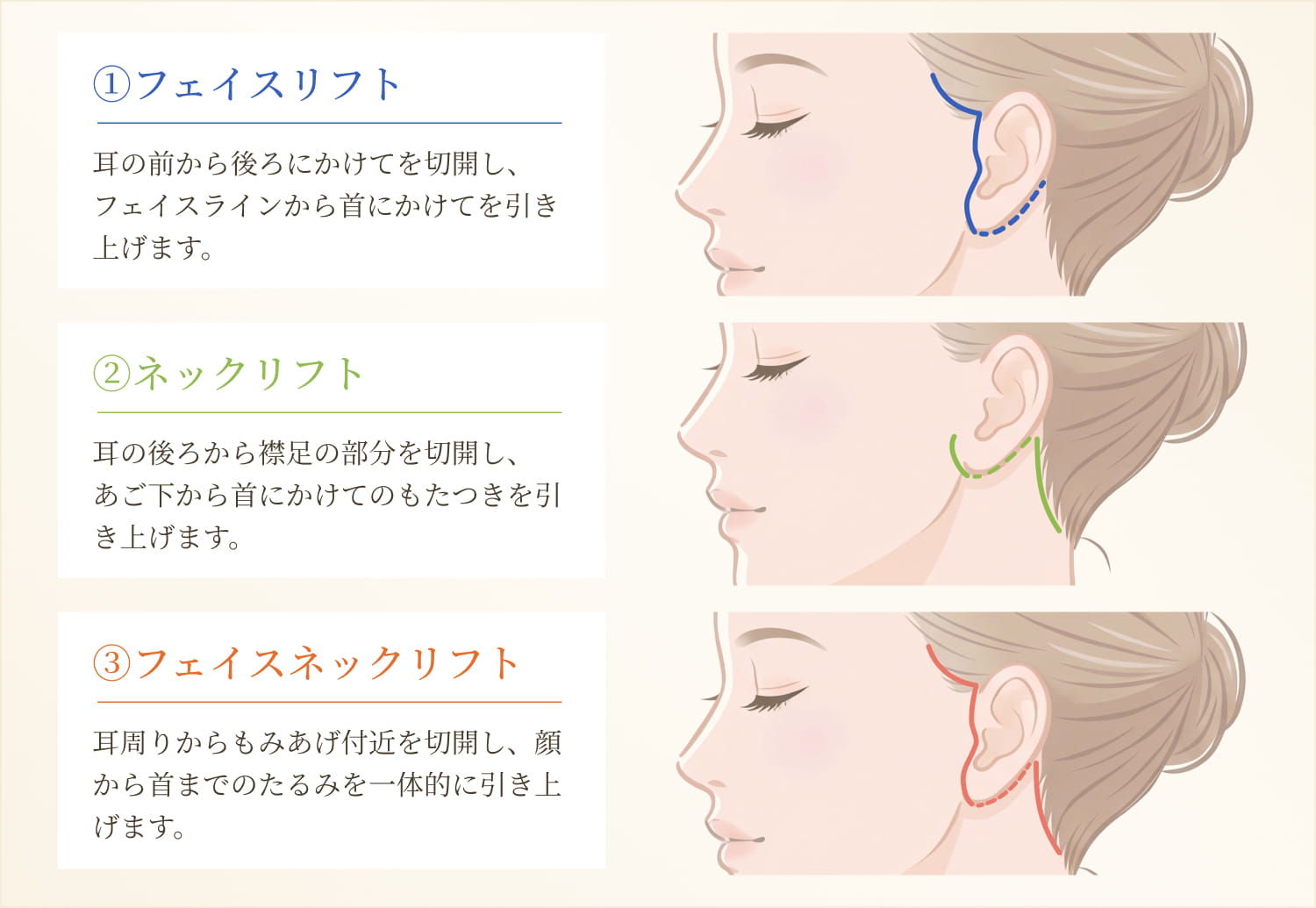 フェイスリフトとネックリフトの手術範囲