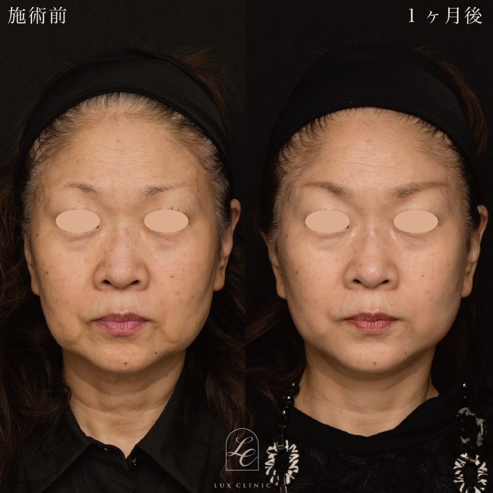 ミニフェイスリフト症例写真01
