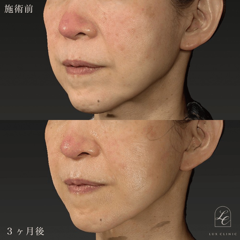 ミニフェイスリフト症例写真05