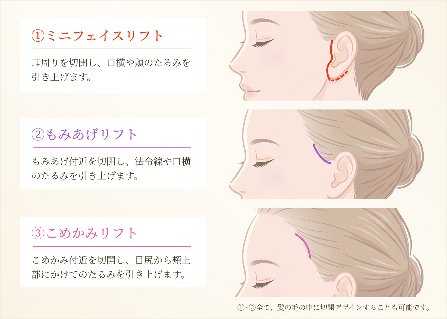 切開範囲を抑えた施術について
