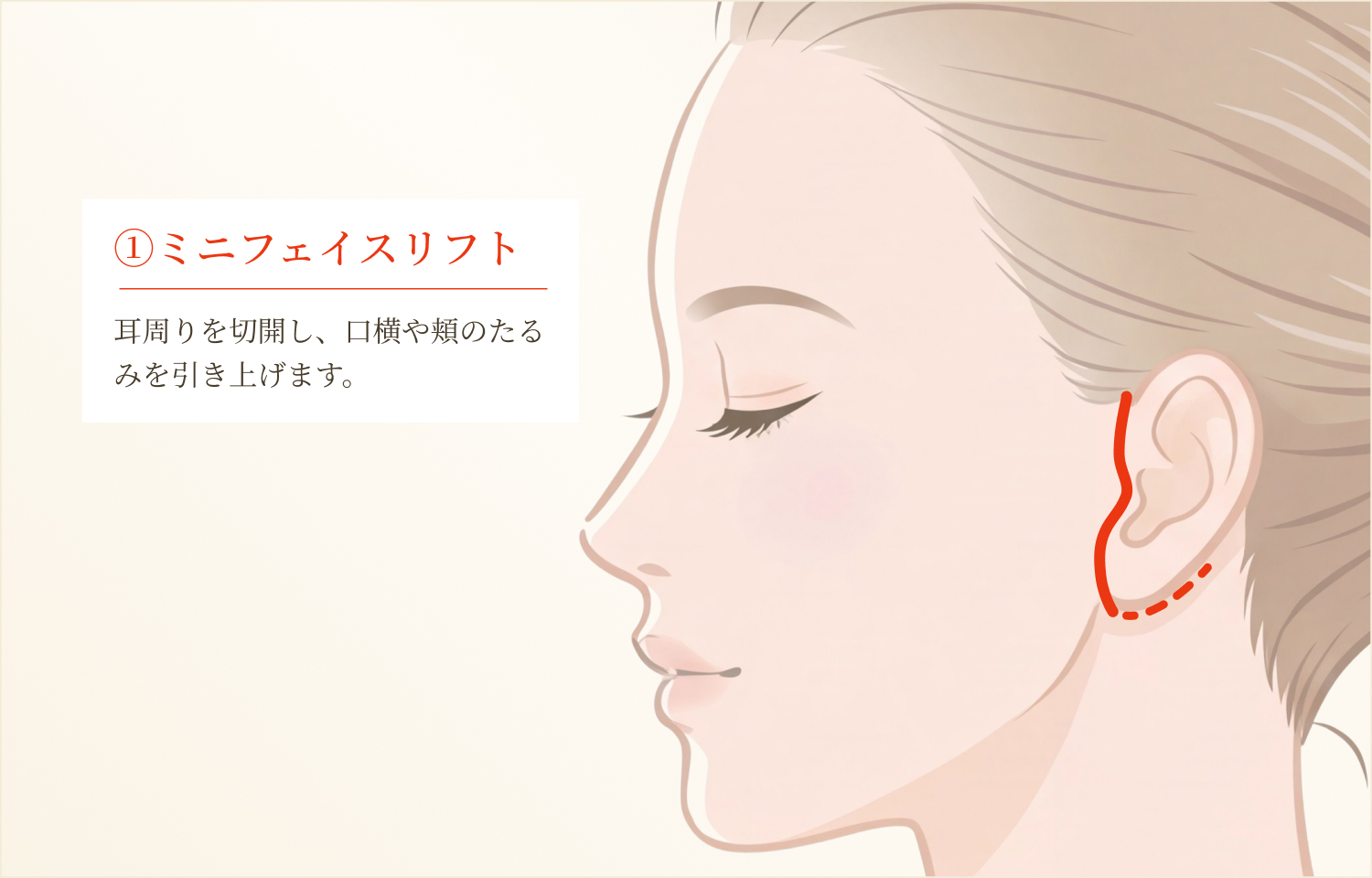 ミニフェイスリフト切開位置