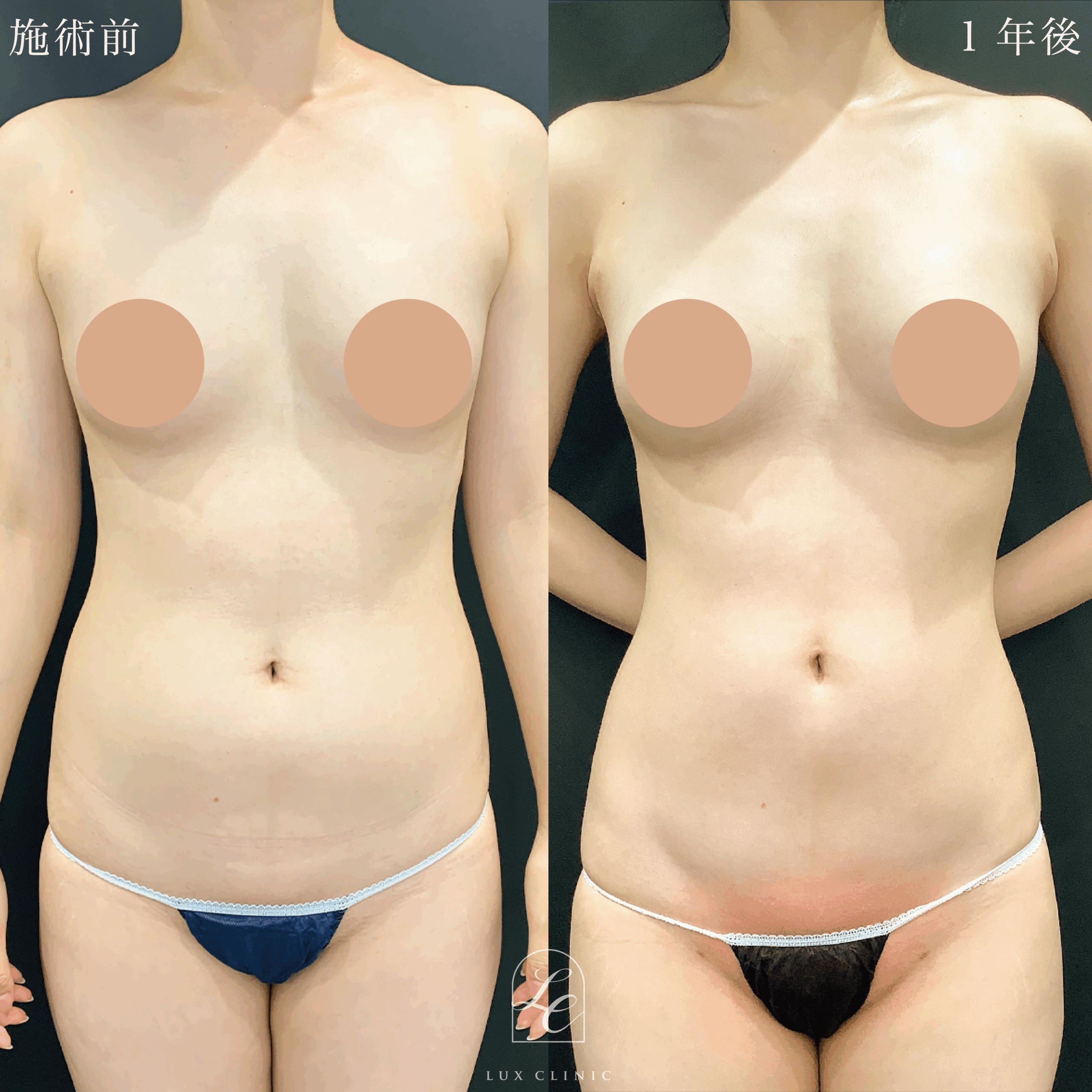 Ultra-Z 脂肪吸引 ＜腹部全面（上・下）・脇腹・腰＞