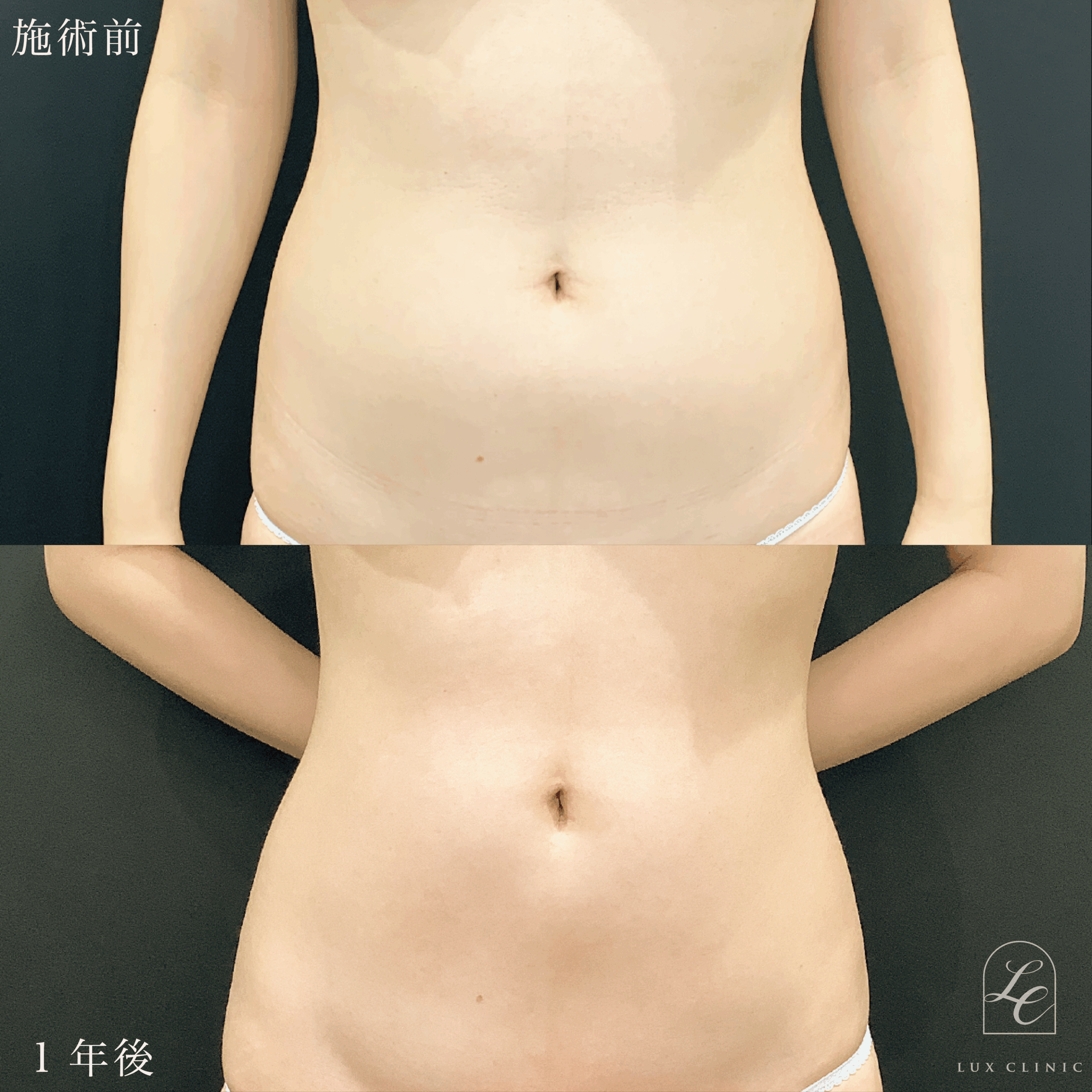 Ultra-Z 脂肪吸引 ＜腹部全面（上・下）・脇腹・腰＞
