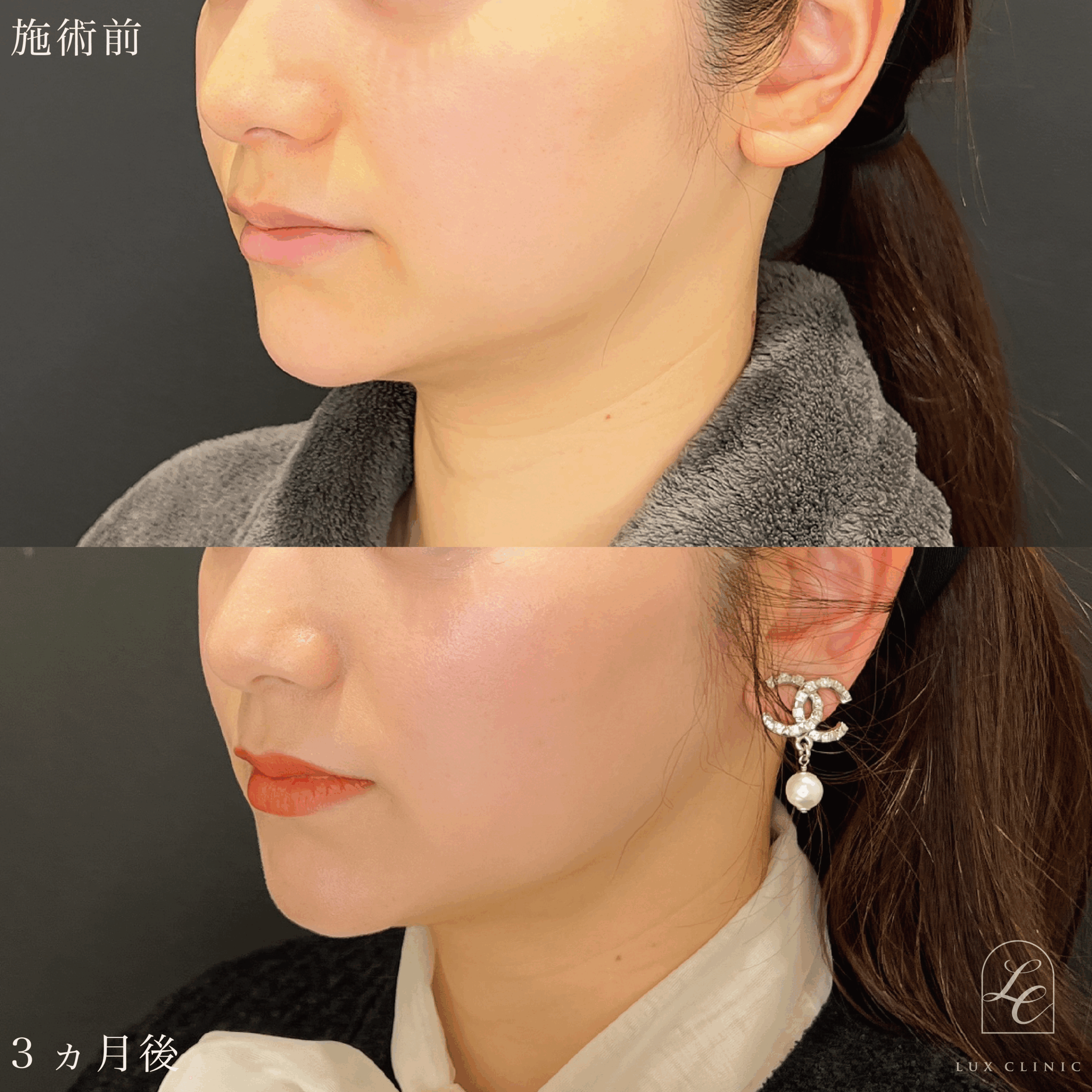 Ultra-Z 脂肪吸引＜あご下＞＋ 糸リフト（テスリフト 4本・BNLS Ultimate Lifting 2本）