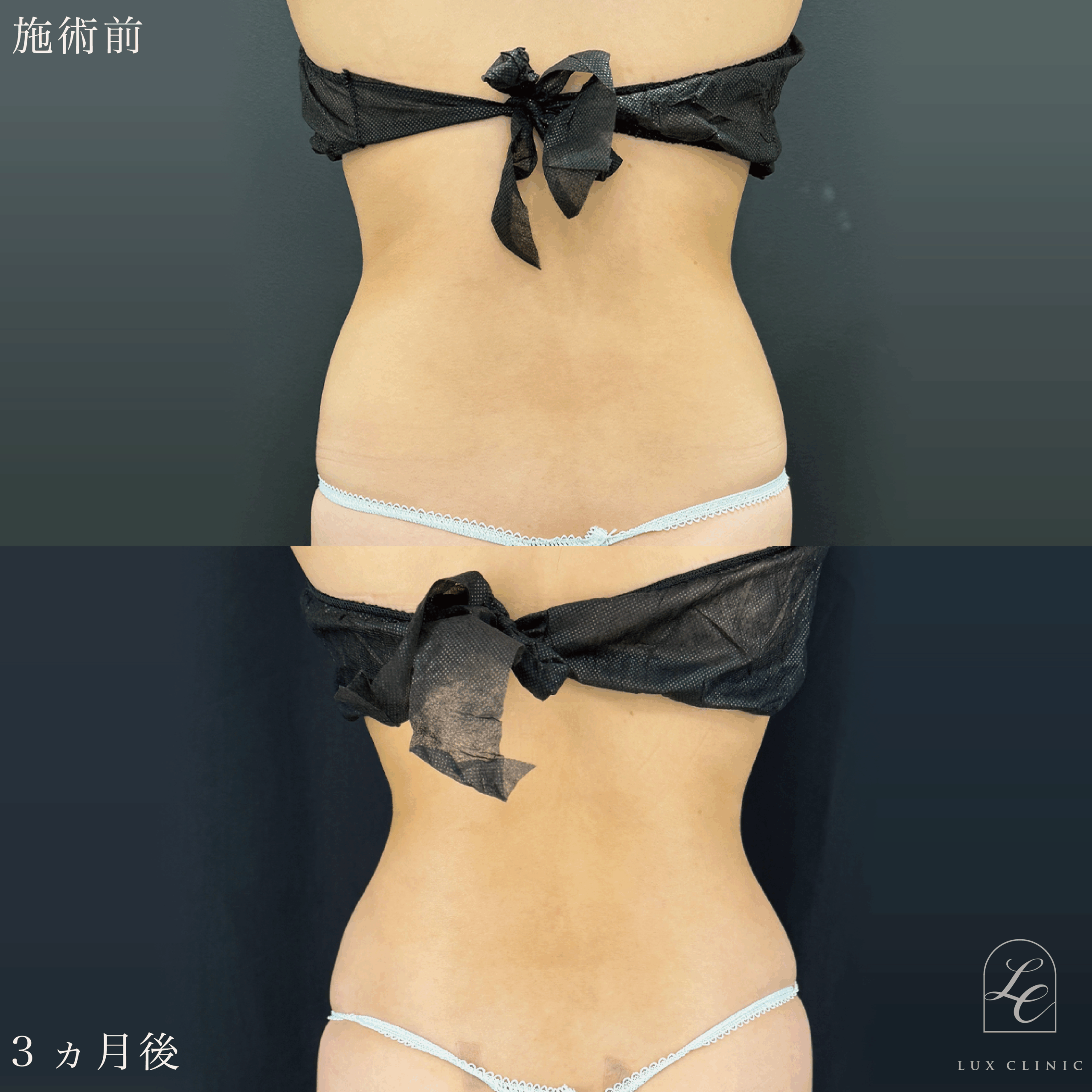 Ultra-Z 脂肪吸引 ＜腹部全面（上・下）・脇腹（前・後）・腰＞