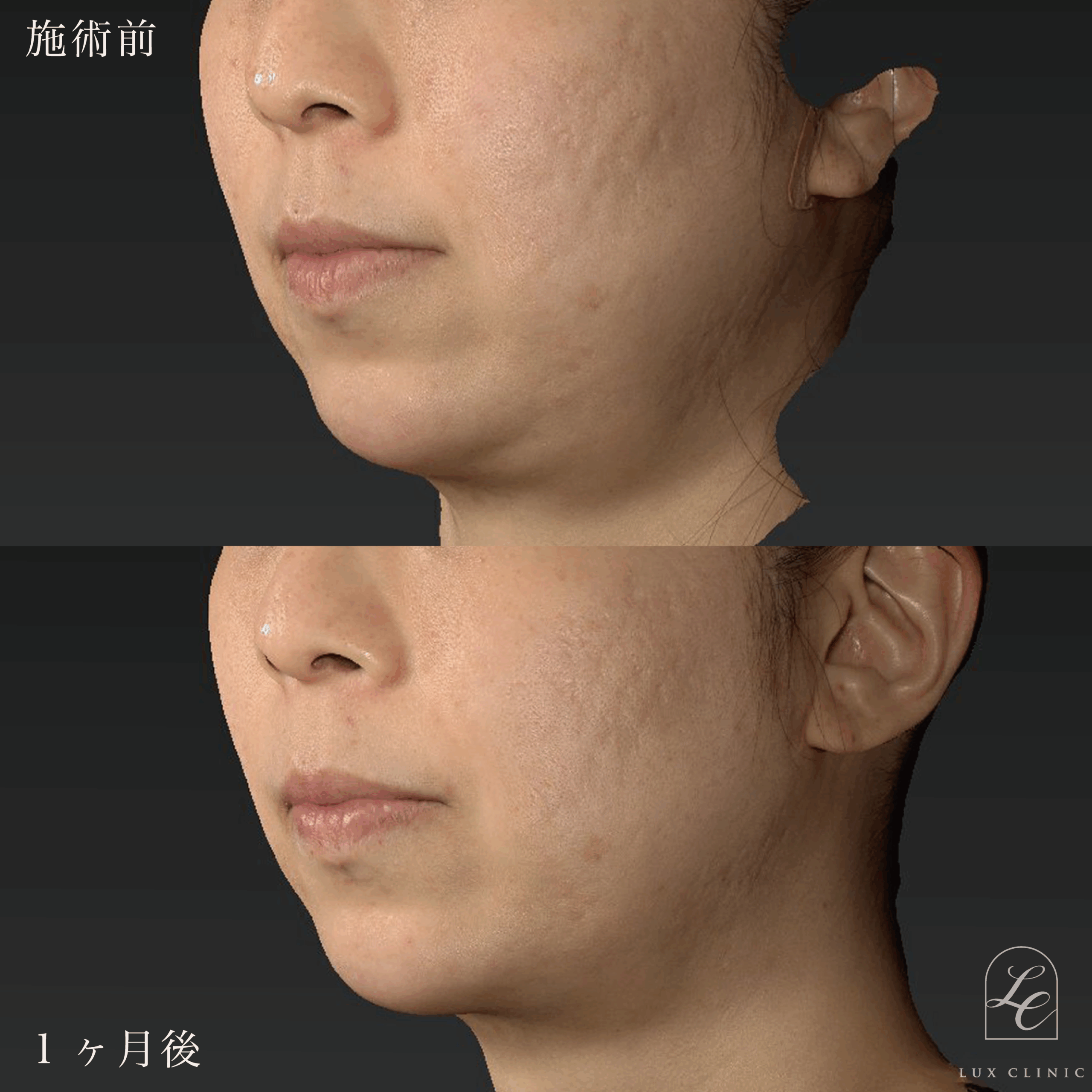 インモードVリフト（miniFX＋FORMA）1 回