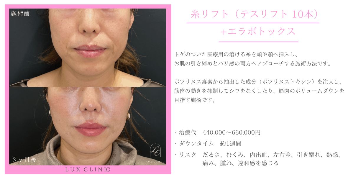 糸リフト テスリフト エラボトックス