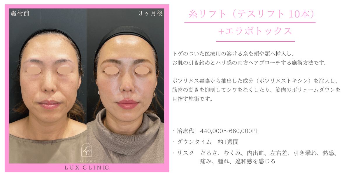 糸リフト テスリフト エラボトックス