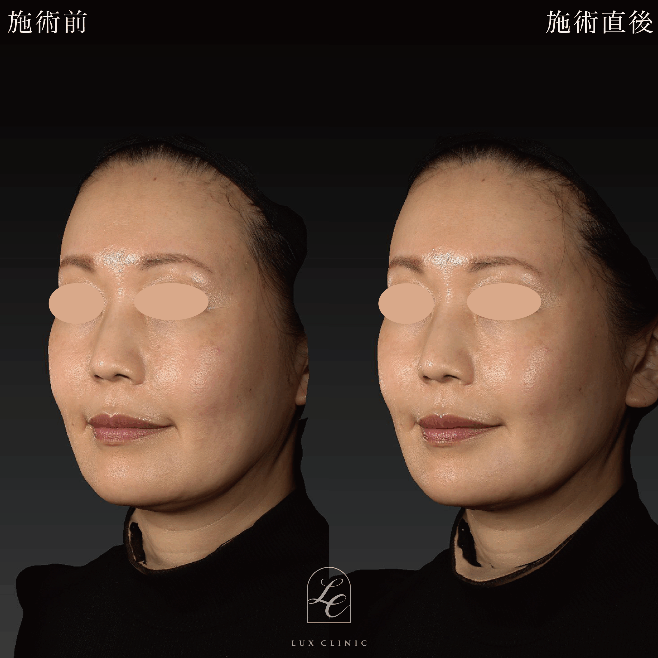 ヒアルロン酸（レスチレン 2本）＜ほうれい線、口角＞