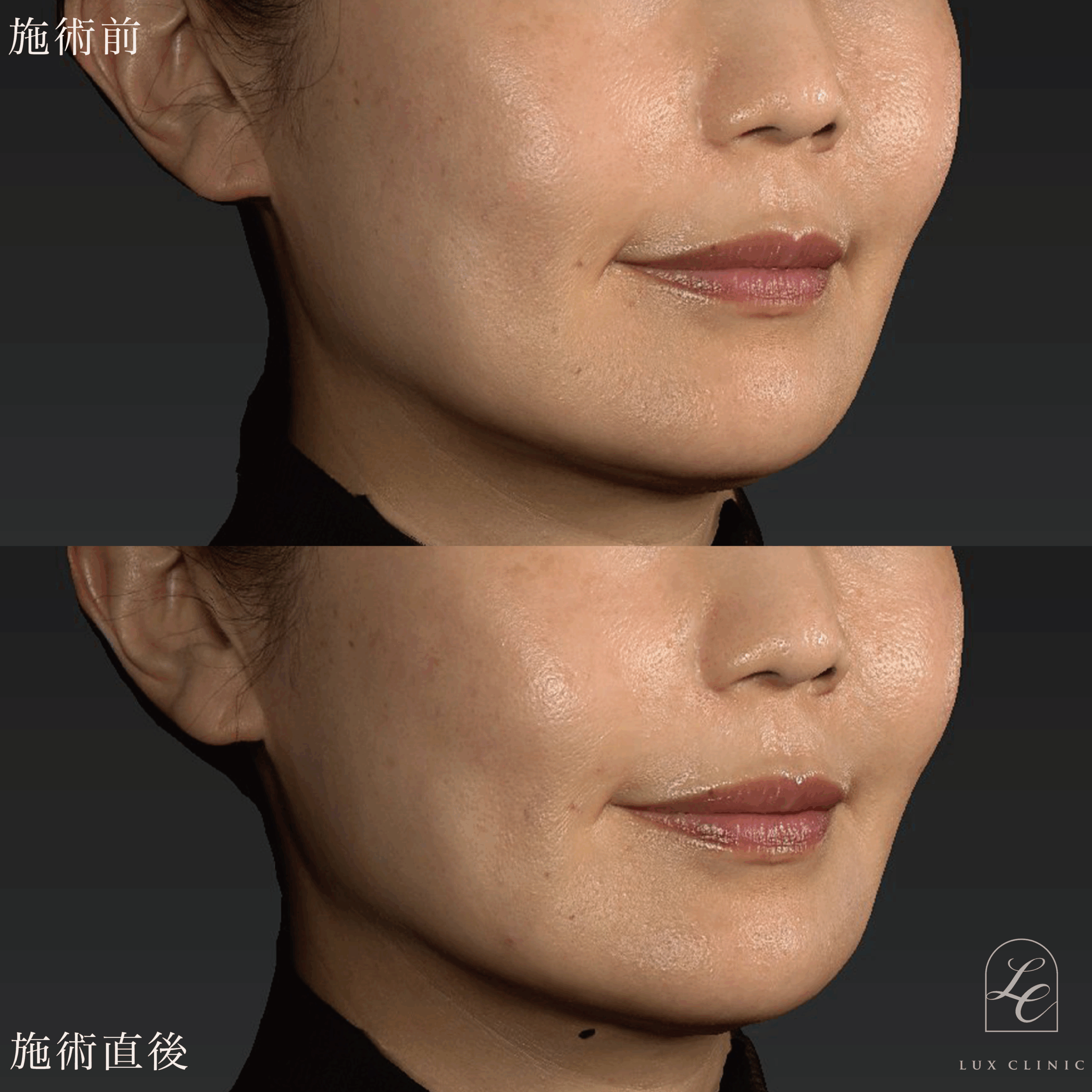 ヒアルロン酸（レスチレン 2本）＜ほうれい線、口角＞