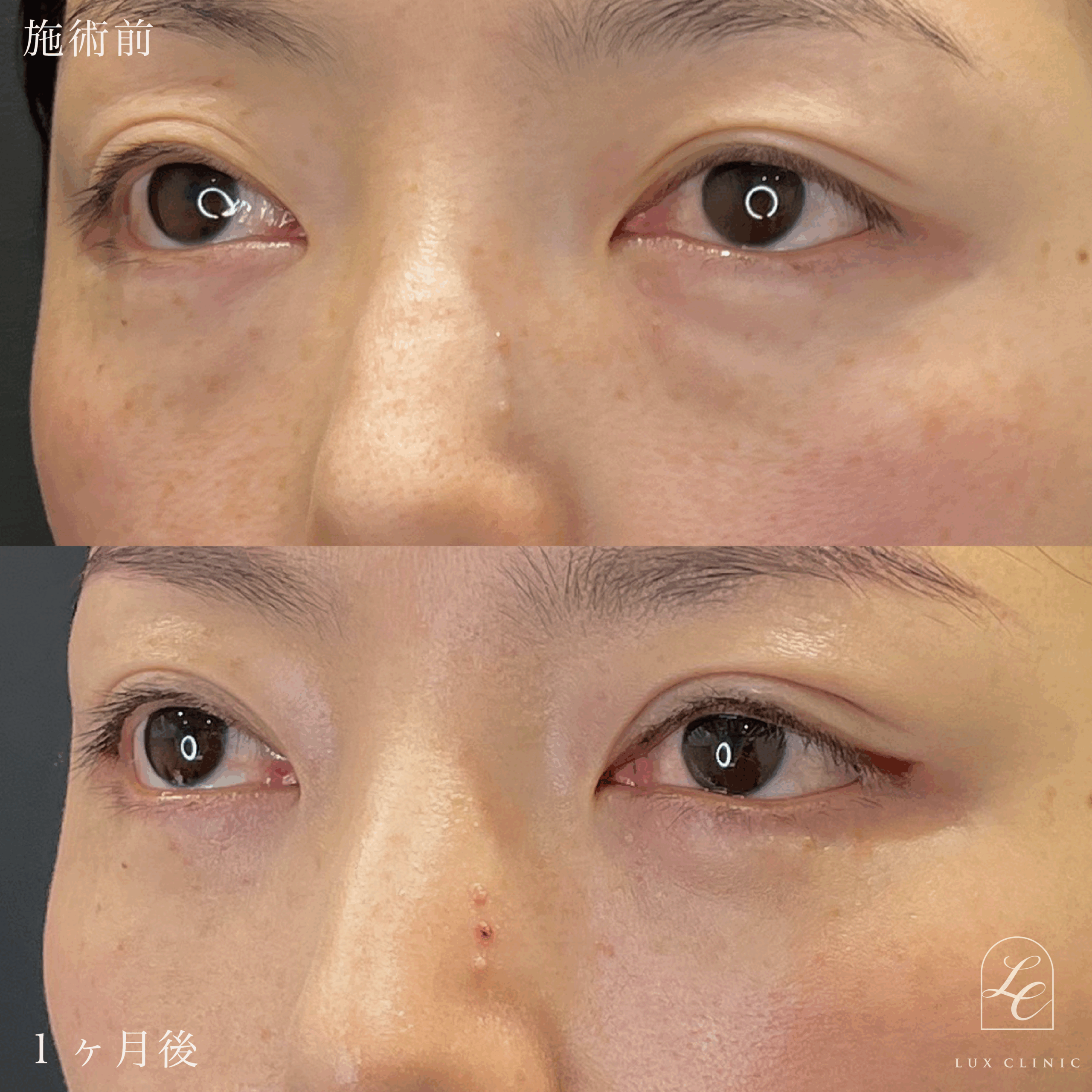 二重埋没法（クイックベーシック法 3点留め） ＋ 目の下のクマ取り、ふくらみ取り（脱脂）術