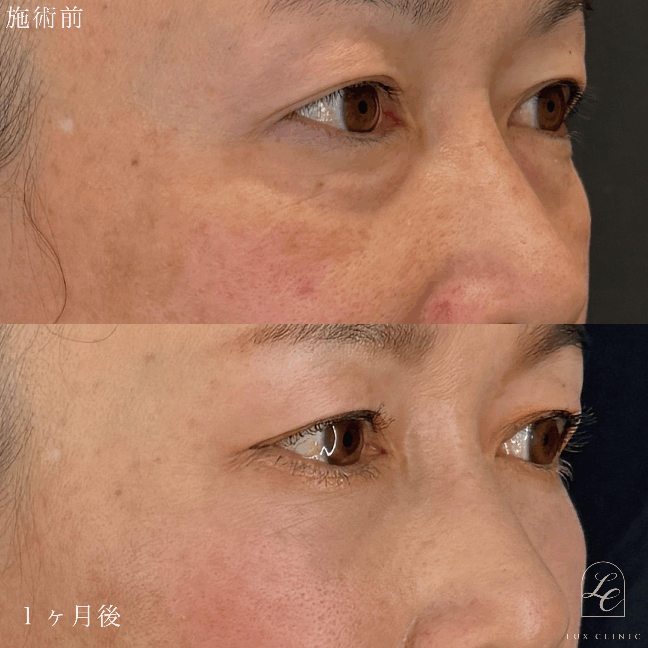 裏ハムラ法