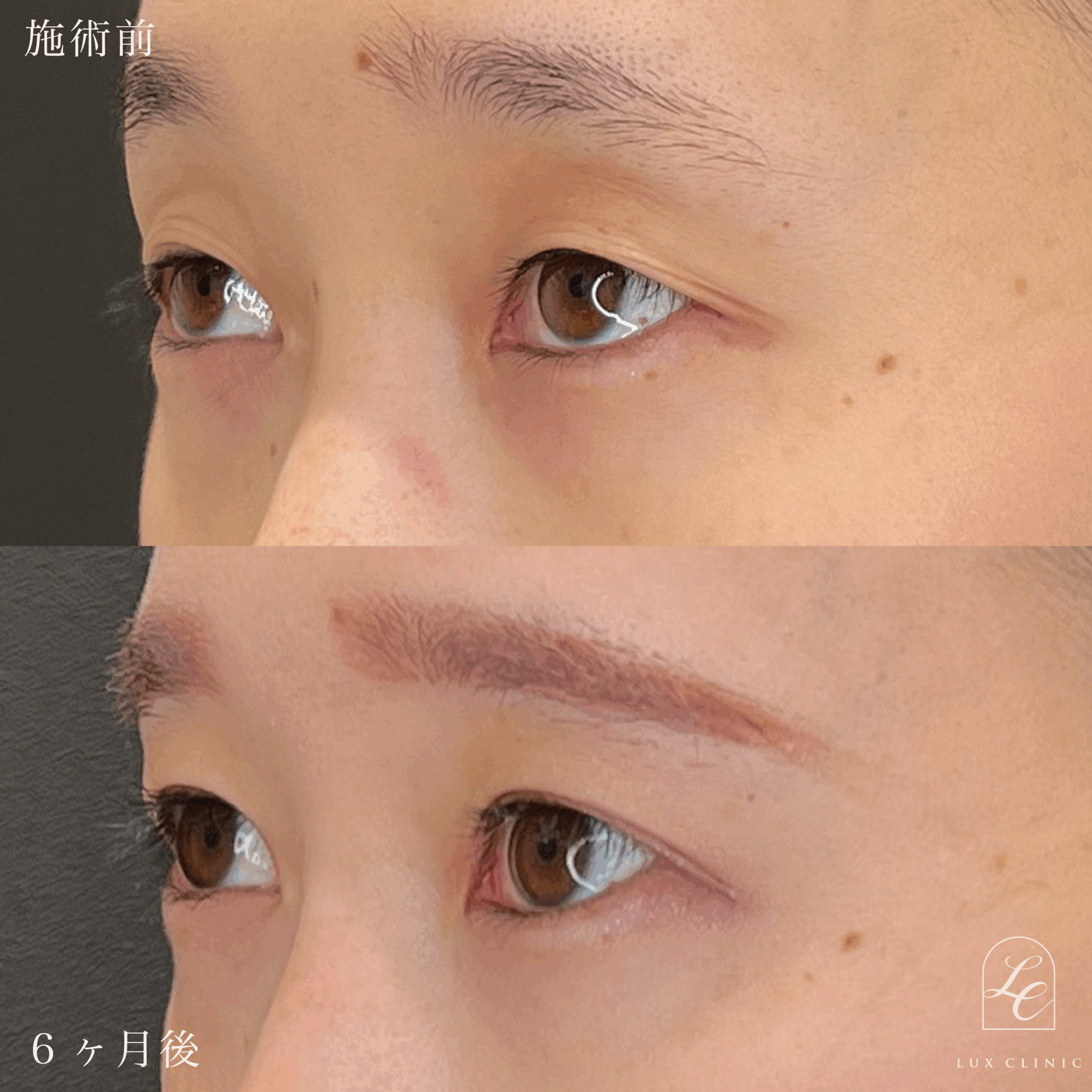 二重埋没法（クイックベーシック法 3点留め）