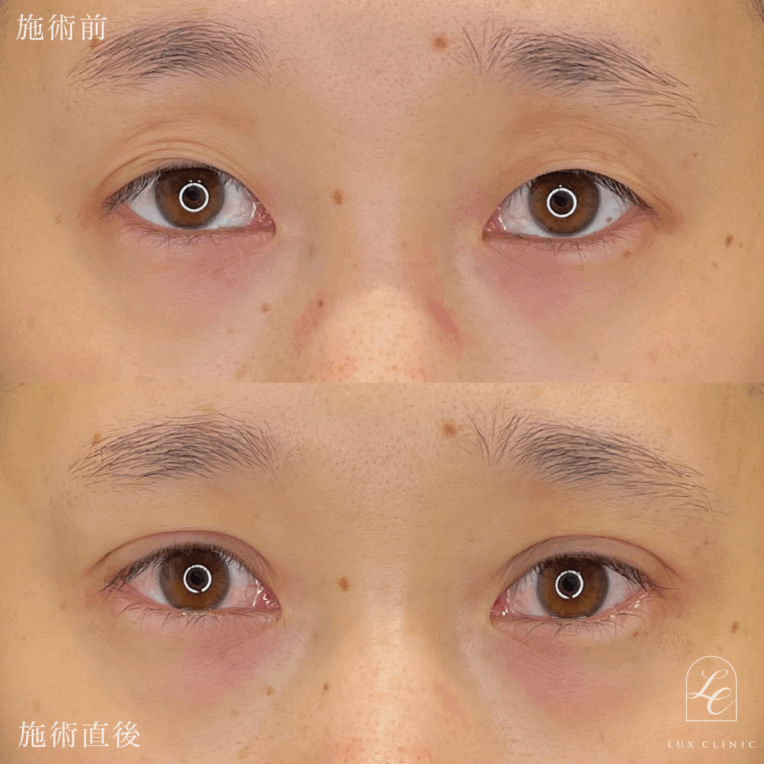 二重埋没法（クイックベーシック法 3点留め）