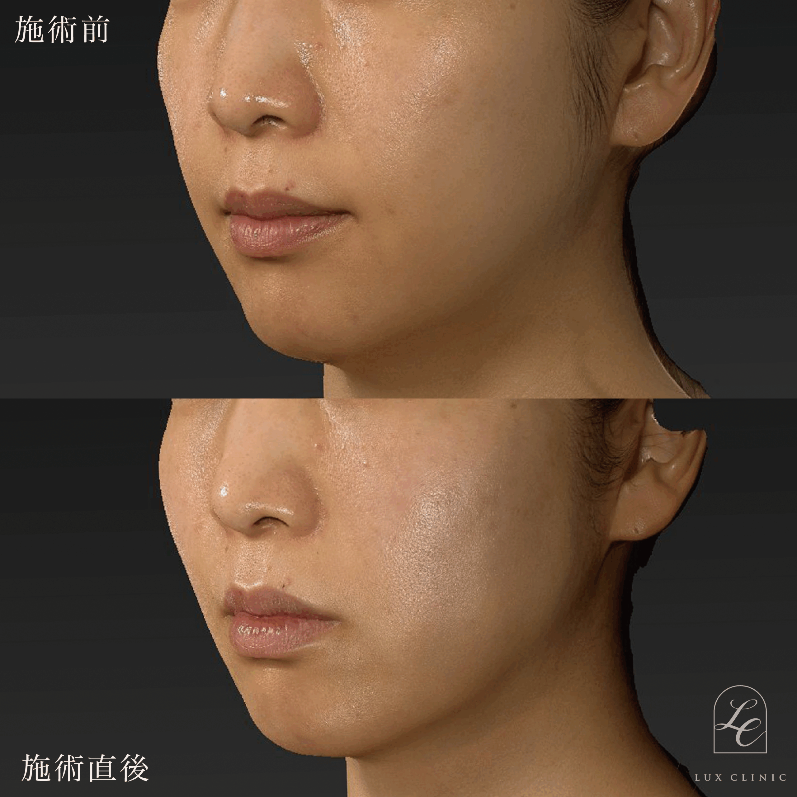 糸リフト（テスリフト 6本）